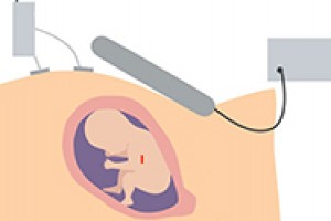 Fetal Pacemaker Ready for Human Trial