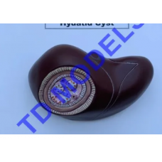 Hydatid Cyst Pathology Model