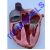Infective Endocarditis Pathology Model