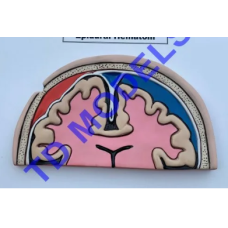 Epidural Hematoma Pathology Model