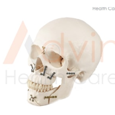 Craniomaxillofacial Implants