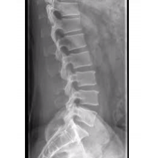 X-RAY LS SPINE LAT VIEW