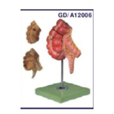 Model of Appendix and Caecum