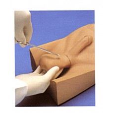 No Scalpel Vasectomy