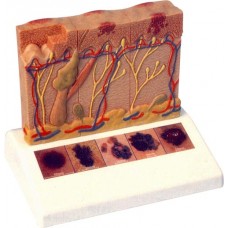 Skin Cancer Model