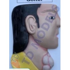 Pathological Goiter Model