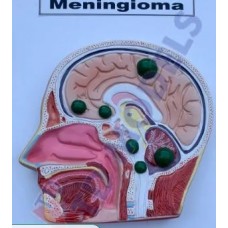 Meningioma Model
