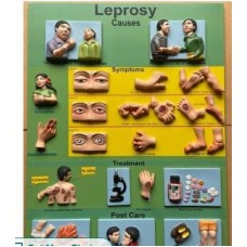 Leprosy Model Showing