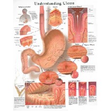 Understanding Ulcers